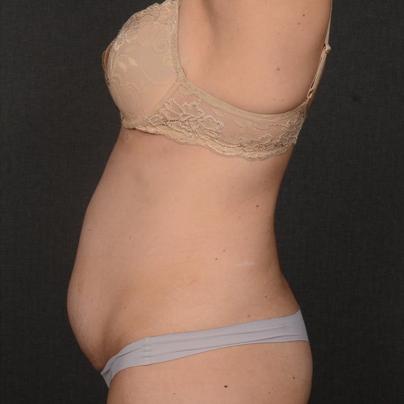 Tummy Tuck Before & After Gallery - Patient 126913 - Image 5