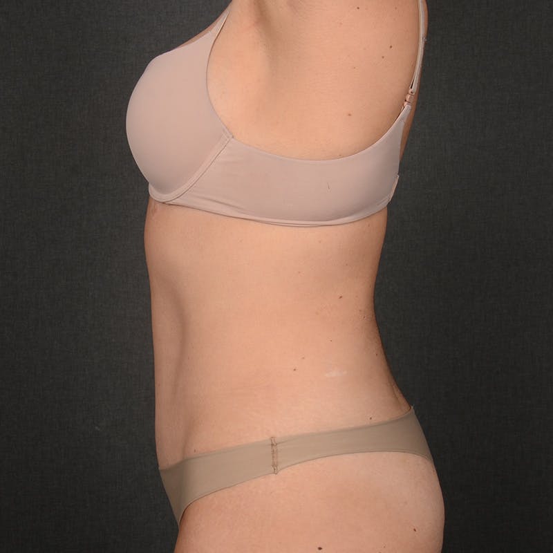 Tummy Tuck Before & After Gallery - Patient 126913 - Image 6