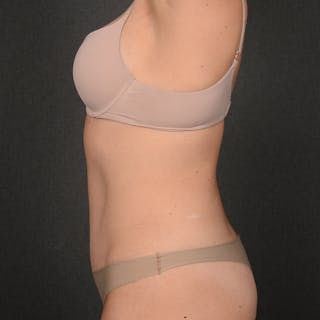 Tummy Tuck Before & After Gallery - Patient 126913 - Image 6