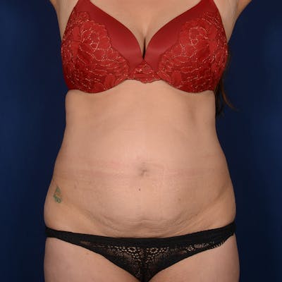 Tummy Tuck Before & After Gallery - Patient 680998 - Image 1