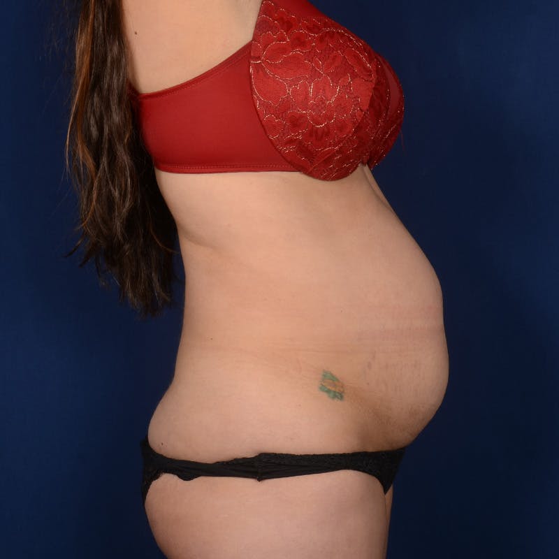 Tummy Tuck Before & After Gallery - Patient 680998 - Image 5