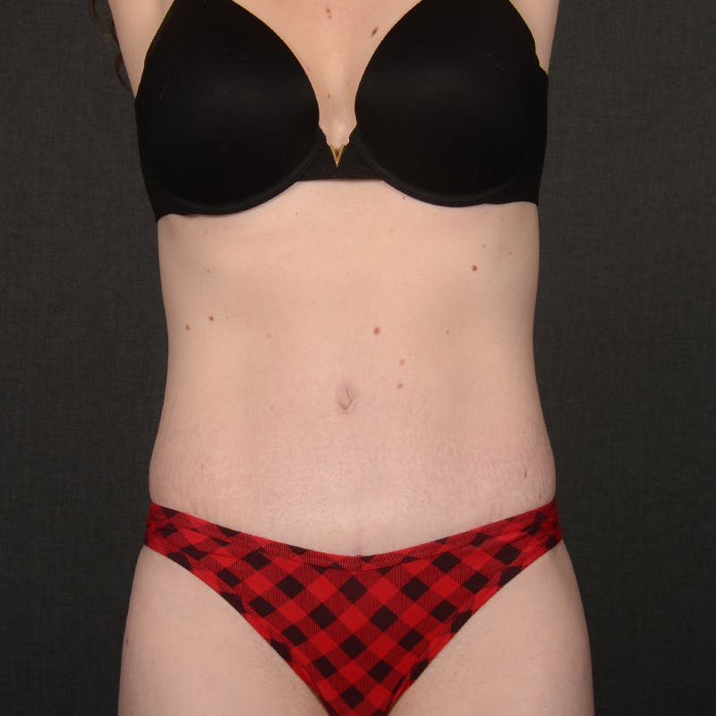 Tummy Tuck Before & After Gallery - Patient 332632 - Image 2