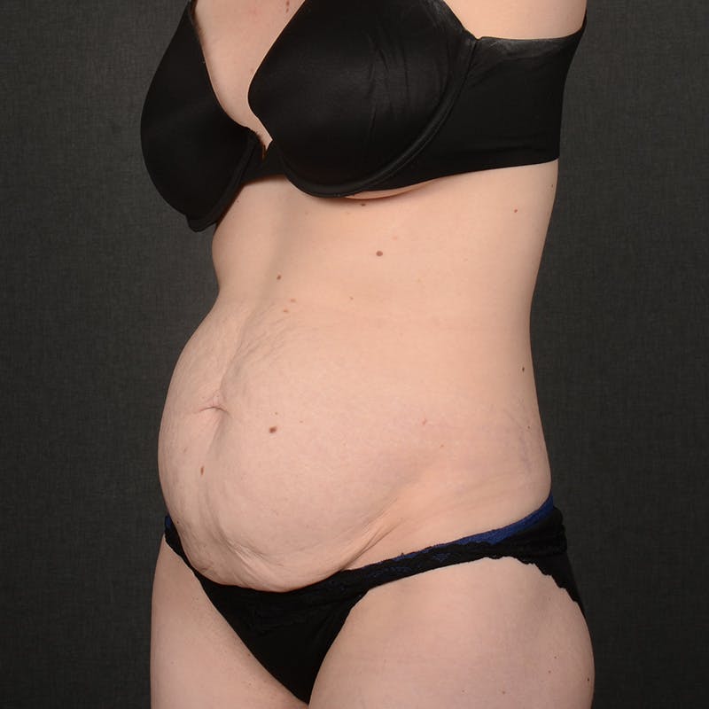 Tummy Tuck Before & After Gallery - Patient 332632 - Image 3