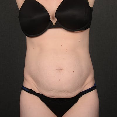 Tummy Tuck Before & After Gallery - Patient 332632 - Image 1