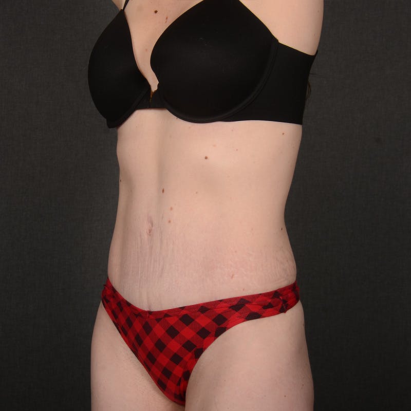 Tummy Tuck Before & After Gallery - Patient 332632 - Image 4