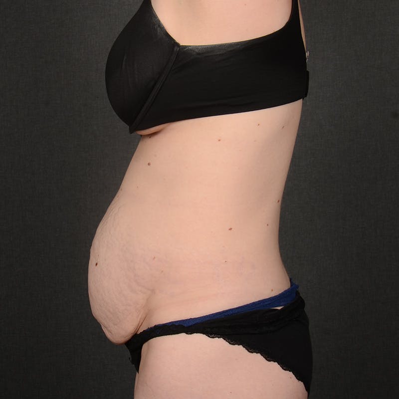 Tummy Tuck Before & After Gallery - Patient 332632 - Image 5