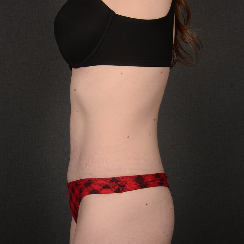 Tummy Tuck Before & After Gallery - Patient 332632 - Image 6