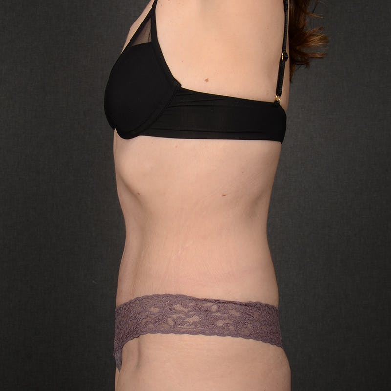 Tummy Tuck Before & After Gallery - Patient 360506 - Image 6