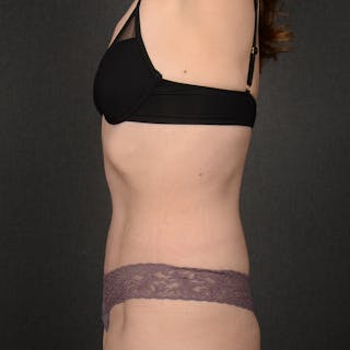 Tummy Tuck Before & After Gallery - Patient 360506 - Image 6