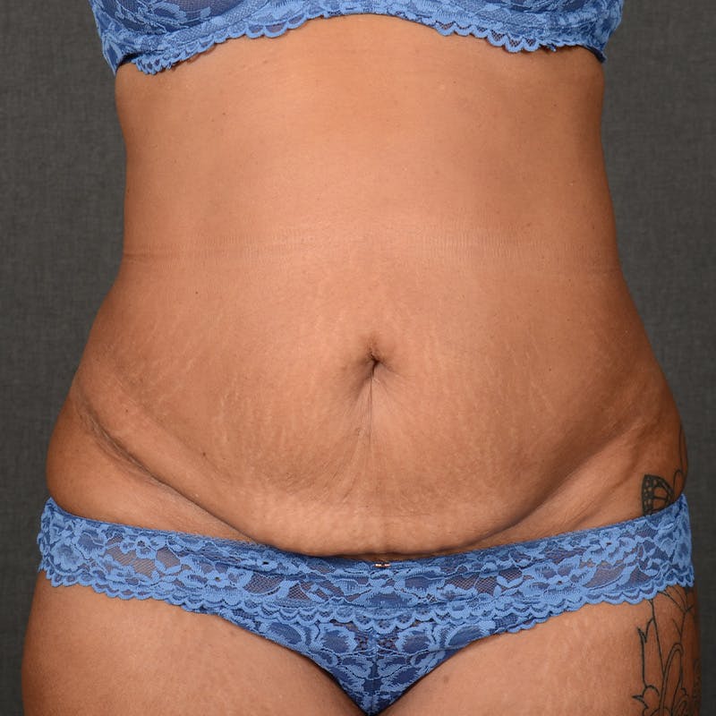 Tummy Tuck Before & After Gallery - Patient 313261 - Image 1
