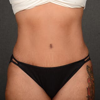 Tummy Tuck Before & After Gallery - Patient 313261 - Image 2
