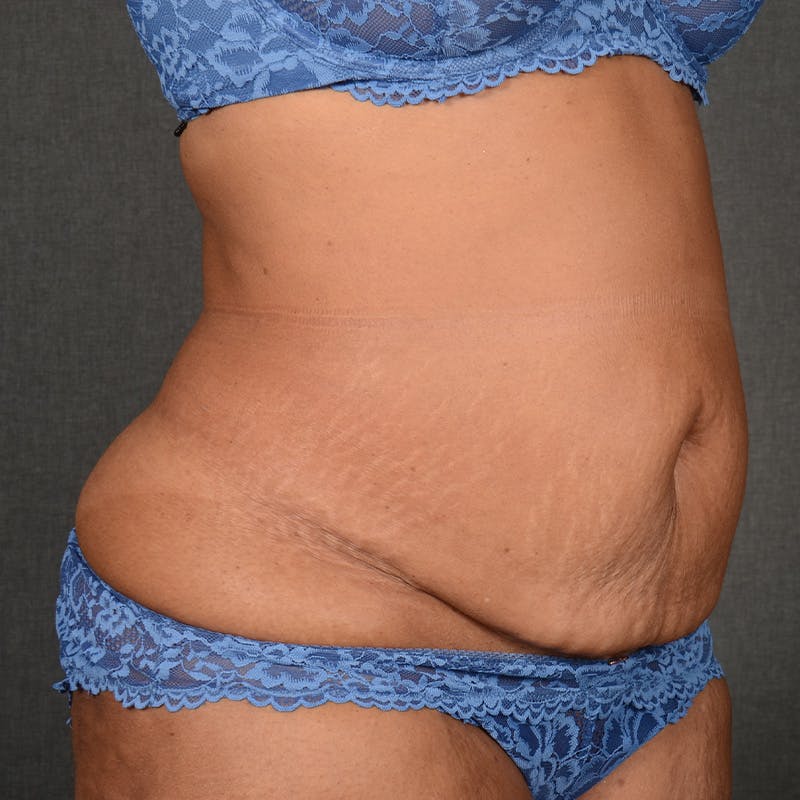 Tummy Tuck Before & After Gallery - Patient 313261 - Image 3