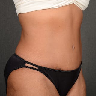 Tummy Tuck Before & After Gallery - Patient 313261 - Image 4