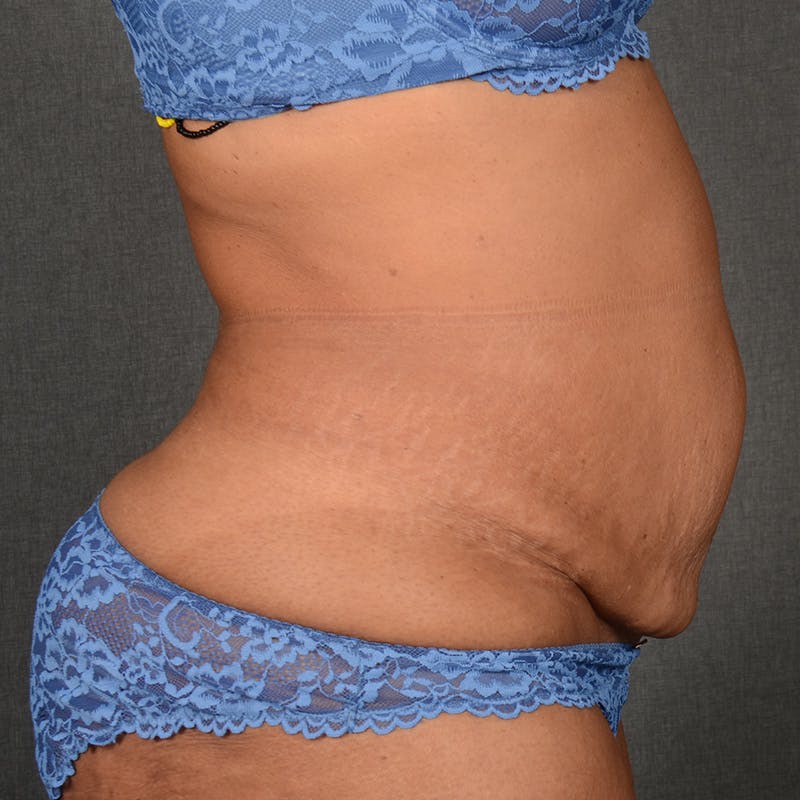 Tummy Tuck Before & After Gallery - Patient 313261 - Image 5