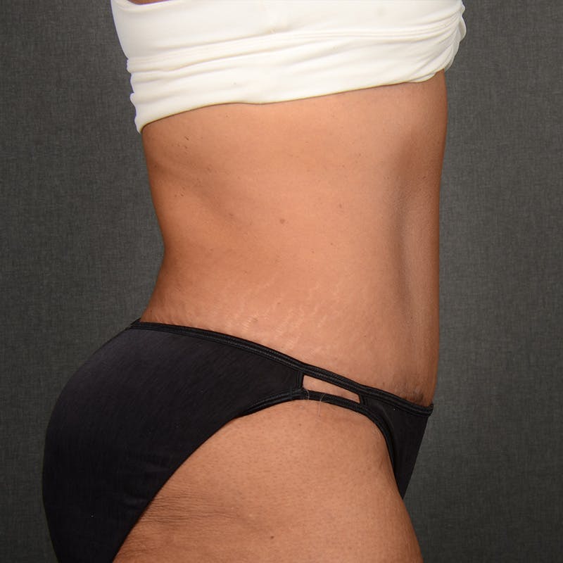 Tummy Tuck Before & After Gallery - Patient 313261 - Image 6
