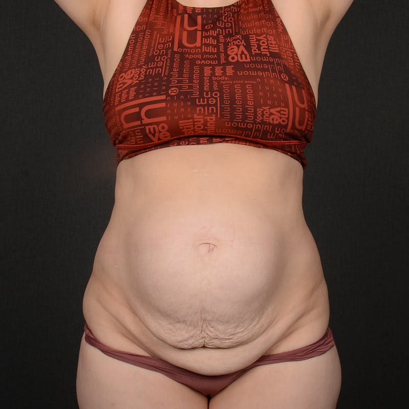 Tummy Tuck Before & After Gallery - Patient 484386 - Image 1