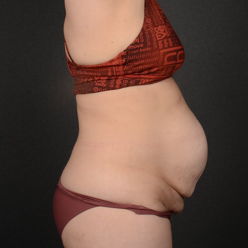 Tummy Tuck Before & After Gallery - Patient 484386 - Image 5
