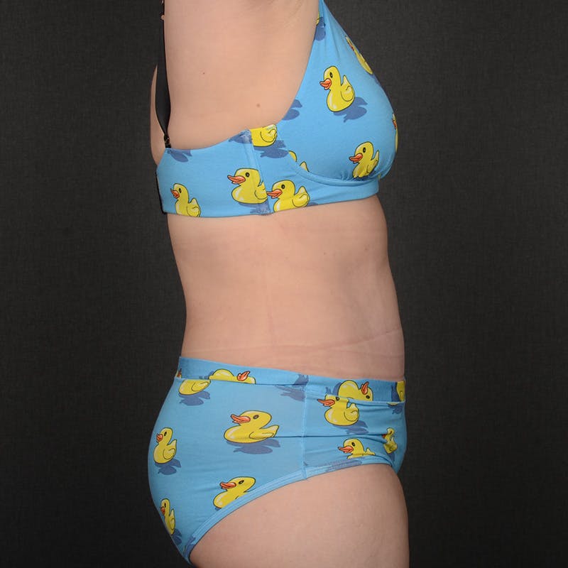 Tummy Tuck Before & After Gallery - Patient 484386 - Image 6