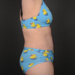 Tummy Tuck Before & After Gallery - Patient 484386 - Image 6