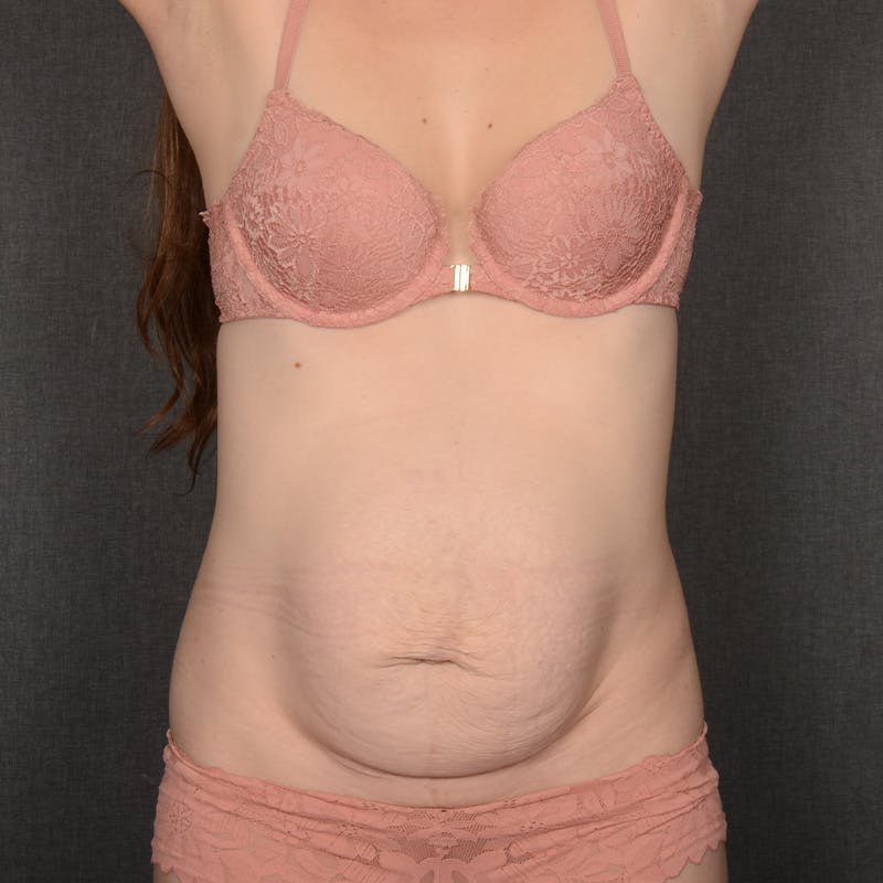 Tummy Tuck Before & After Gallery - Patient 305436 - Image 1