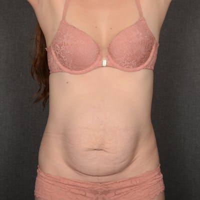 Tummy Tuck Before & After Gallery - Patient 305436 - Image 1