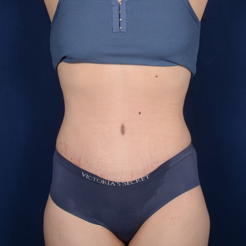 Tummy Tuck Before & After Gallery - Patient 134757 - Image 2