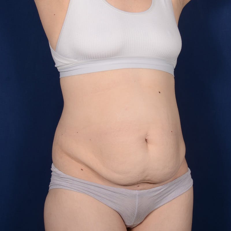 Tummy Tuck Before & After Gallery - Patient 134757 - Image 3
