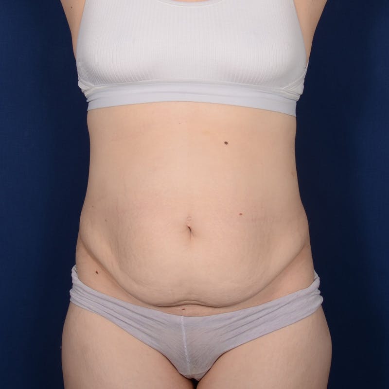 Tummy Tuck Before & After Gallery - Patient 134757 - Image 1