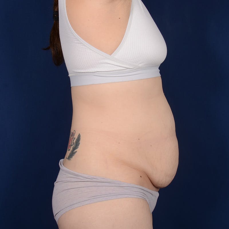 Tummy Tuck Before & After Gallery - Patient 134757 - Image 5