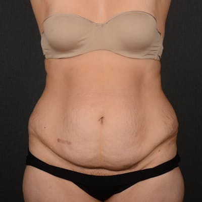 Tummy Tuck Before & After Gallery - Patient 142266 - Image 1
