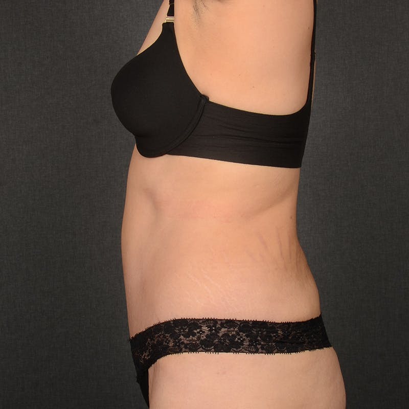 Tummy Tuck Before & After Gallery - Patient 142266 - Image 6