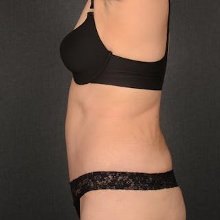 Tummy Tuck Before & After Gallery - Patient 142266 - Image 6
