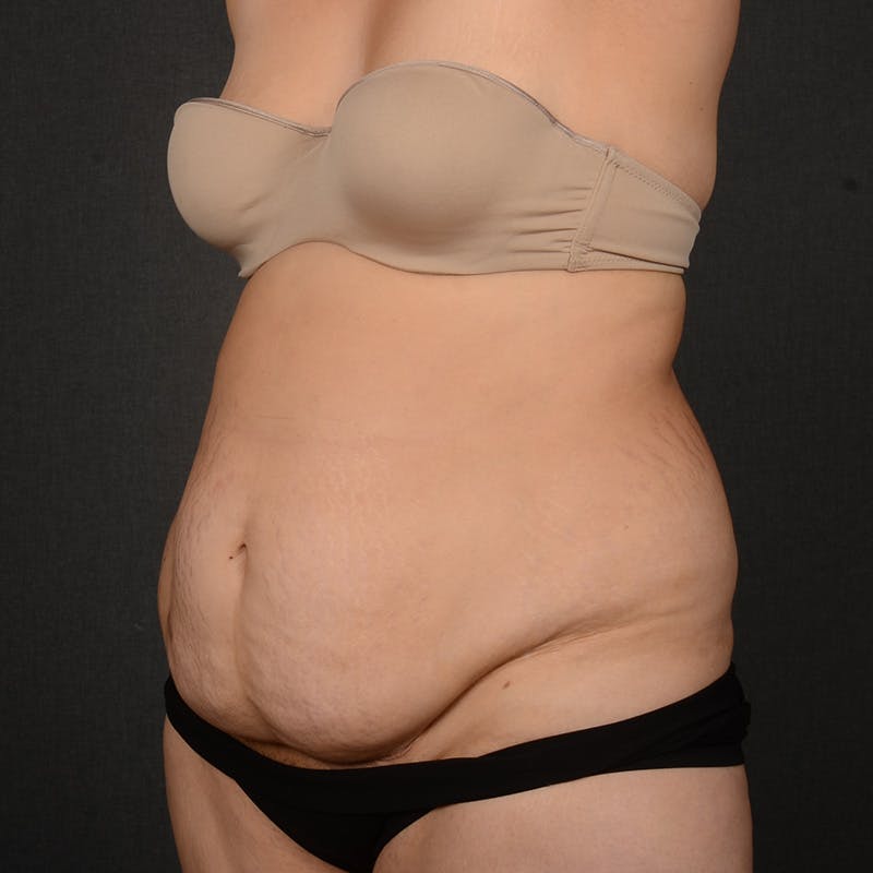 Tummy Tuck Before & After Gallery - Patient 142266 - Image 3