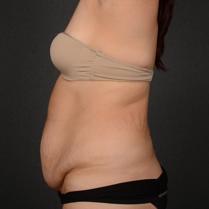 Tummy Tuck Before & After Gallery - Patient 142266 - Image 5