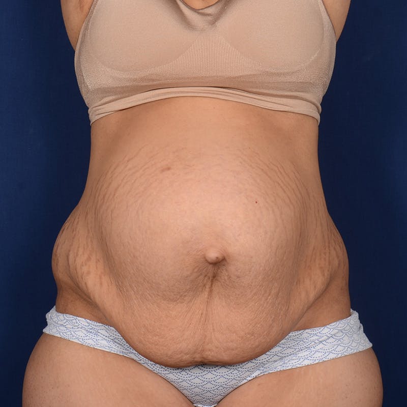 Tummy Tuck Before & After Gallery - Patient 420031 - Image 1
