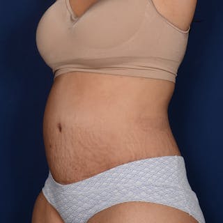 Tummy Tuck Before & After Gallery - Patient 420031 - Image 4
