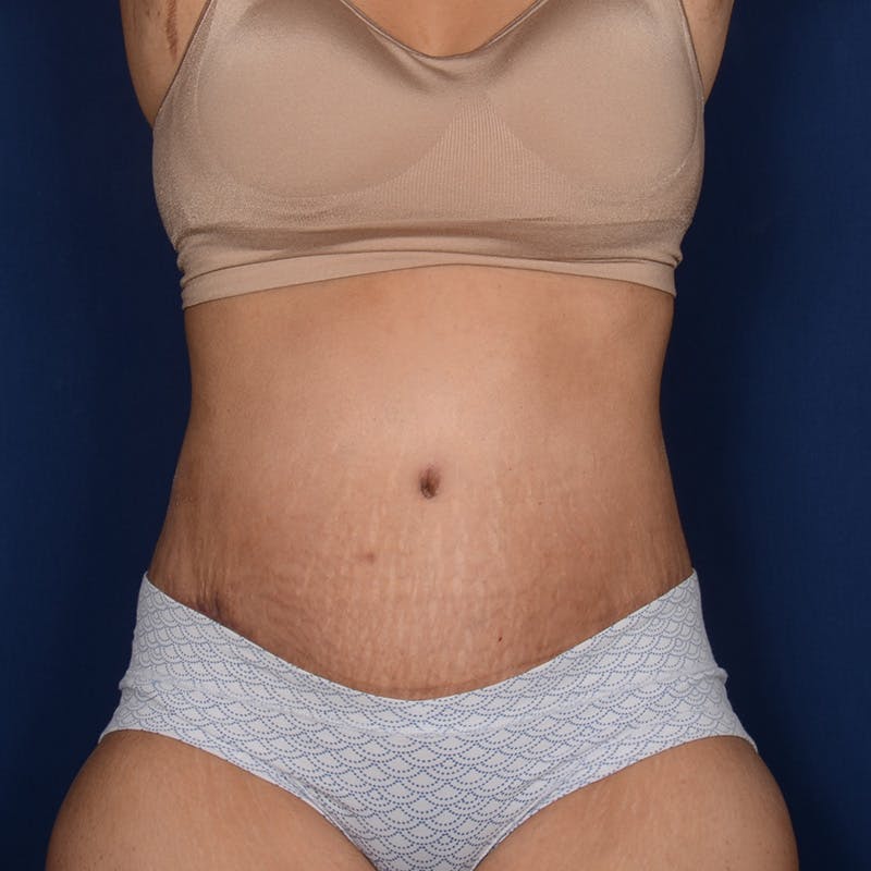 Tummy Tuck Before & After Gallery - Patient 420031 - Image 2