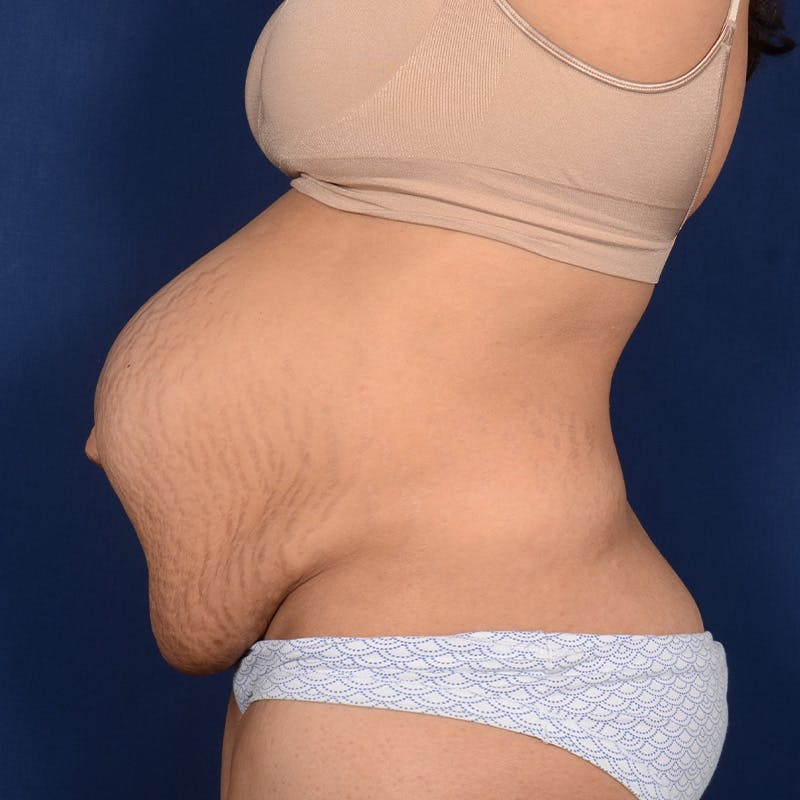 Tummy Tuck Before & After Gallery - Patient 420031 - Image 5