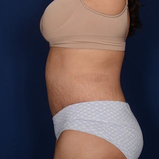Tummy Tuck Before & After Gallery - Patient 420031 - Image 6