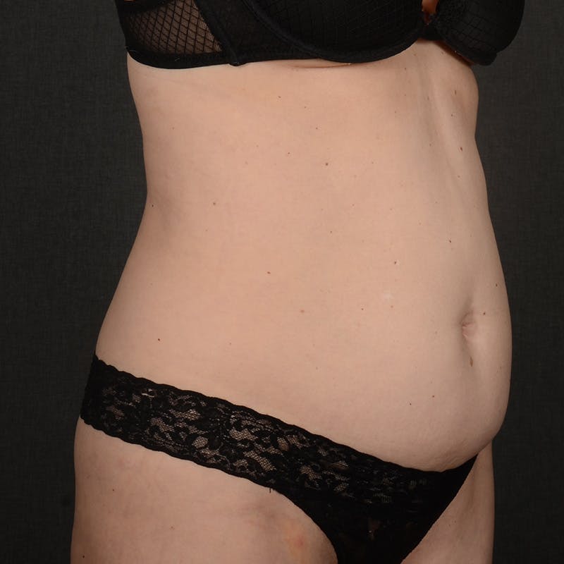 Tummy Tuck Before & After Gallery - Patient 290090 - Image 3