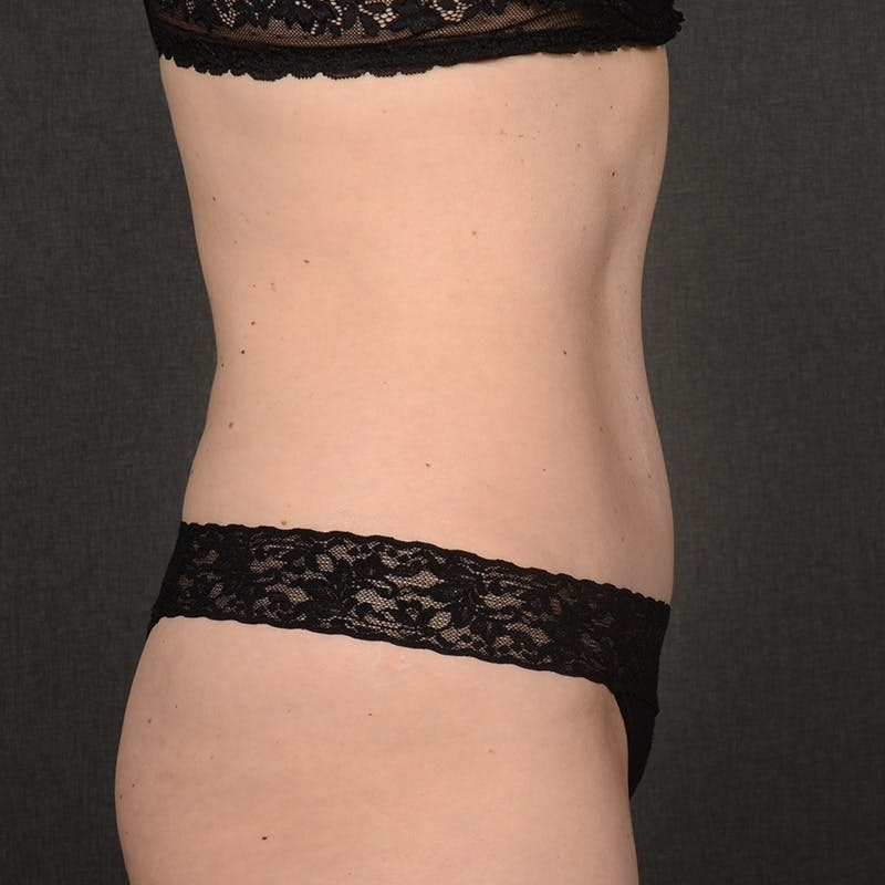 Tummy Tuck Before & After Gallery - Patient 290090 - Image 6