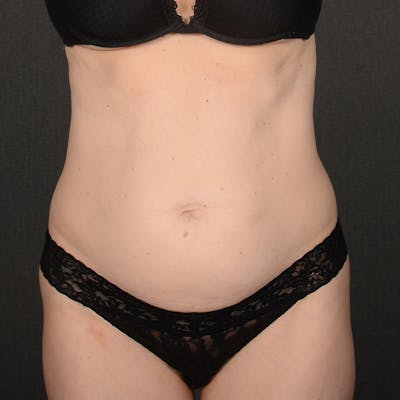 Tummy Tuck Before & After Gallery - Patient 290090 - Image 1