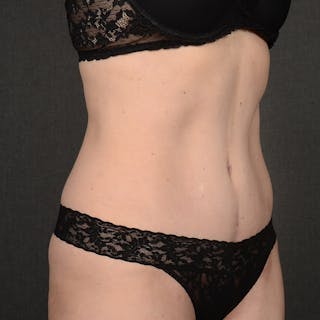 Tummy Tuck Before & After Gallery - Patient 290090 - Image 4