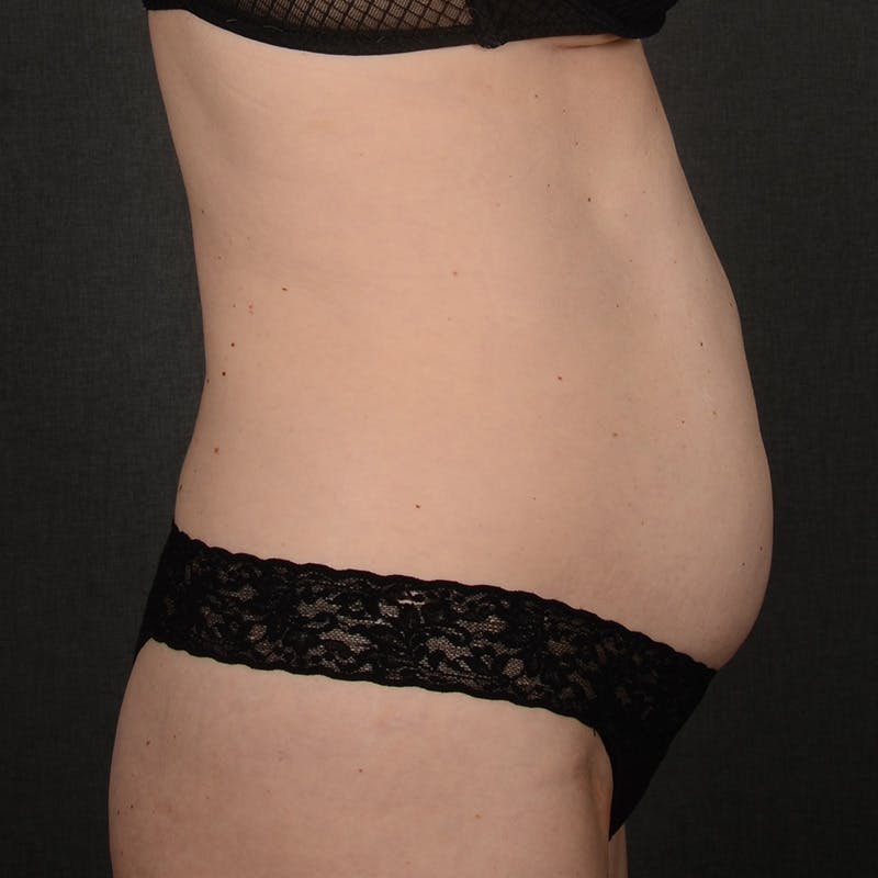 Tummy Tuck Before & After Gallery - Patient 290090 - Image 5