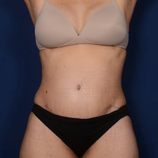 Tummy Tuck Before & After Gallery - Patient 420389 - Image 2