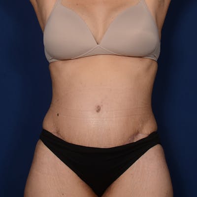 Tummy Tuck Before & After Gallery - Patient 420389 - Image 2