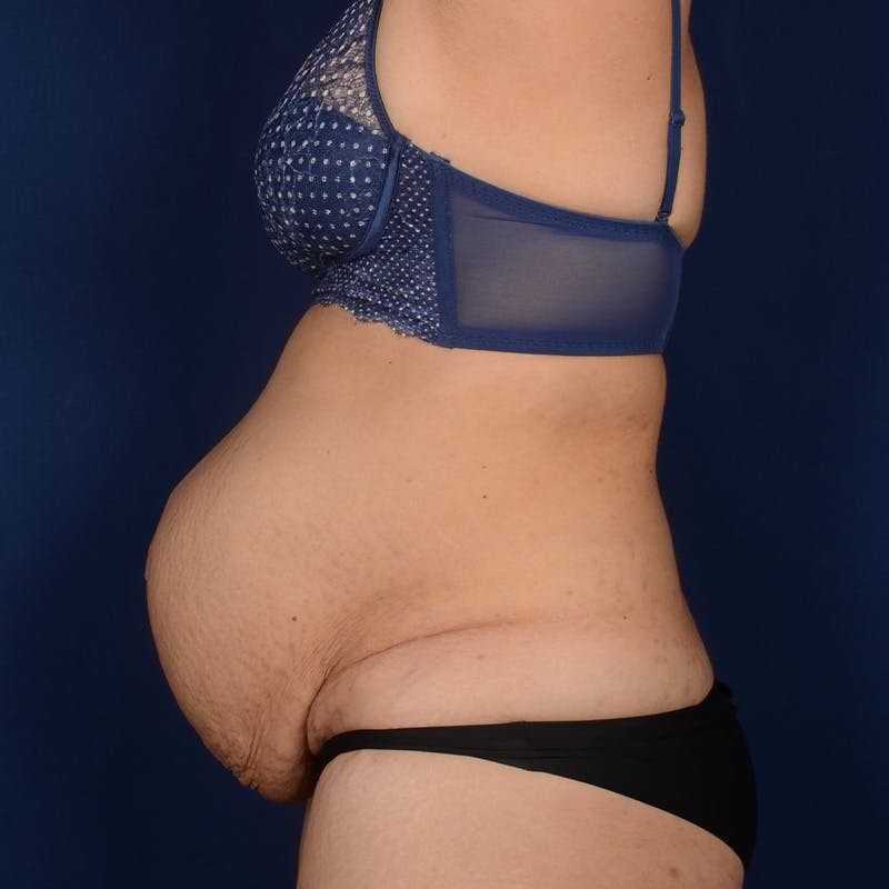 Tummy Tuck Before & After Gallery - Patient 420389 - Image 5