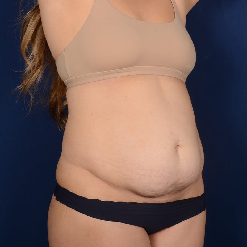 Tummy Tuck Before & After Gallery - Patient 288953 - Image 3