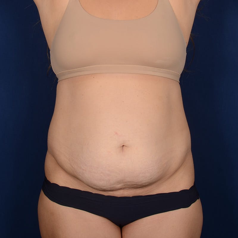 Tummy Tuck Before & After Gallery - Patient 288953 - Image 1