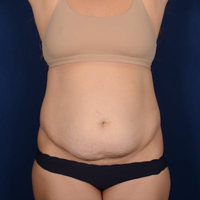 Tummy Tuck Before & After Gallery - Patient 288953 - Image 1